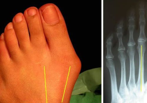 Bunion Surgery