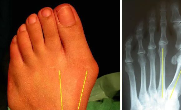 Bunion Surgery