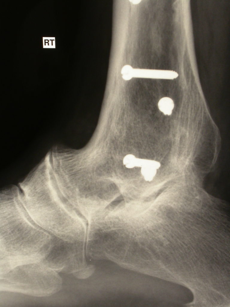 Ankle Replacement The Foot and Ankle Clinic