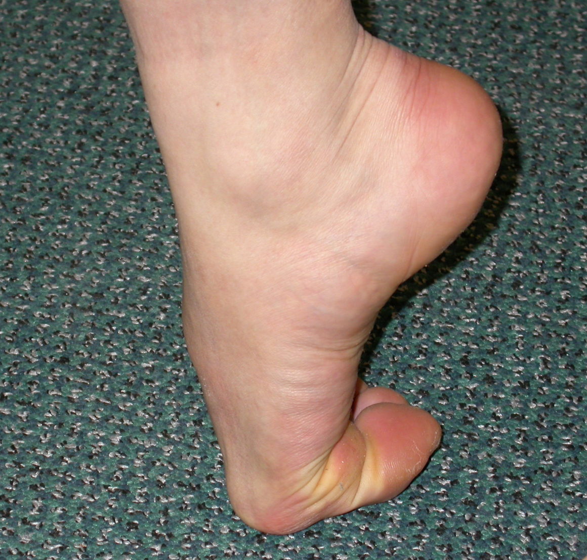 Hallux Rigidus (Big Toe Arthritis)