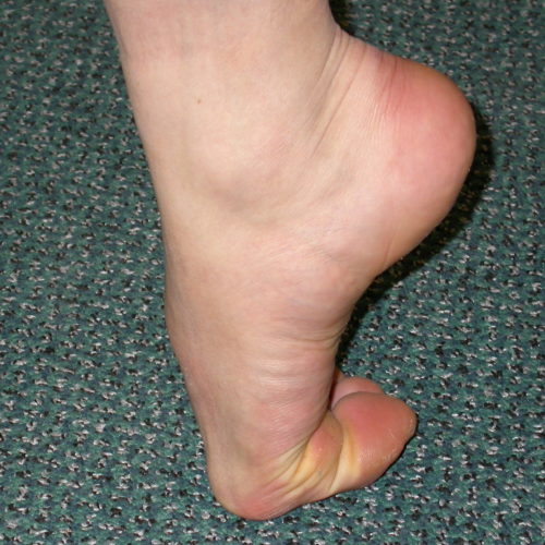 Hallux Rigidus (Big Toe Arthritis)