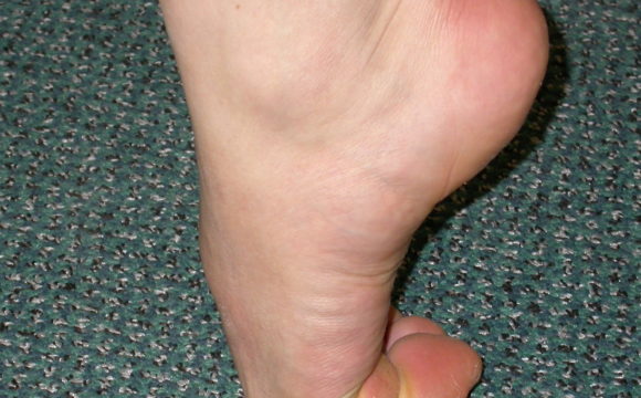 Hallux Rigidus (Big Toe Arthritis)