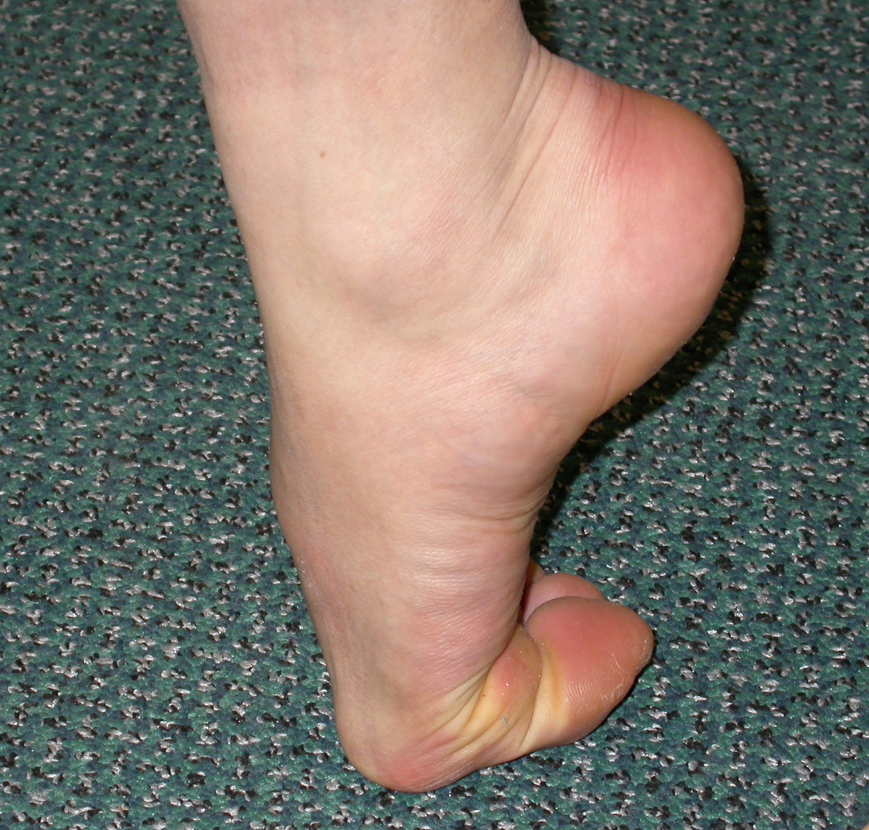 Hallux Rigidus (Big Toe Arthritis) - The Foot and Ankle Clinic