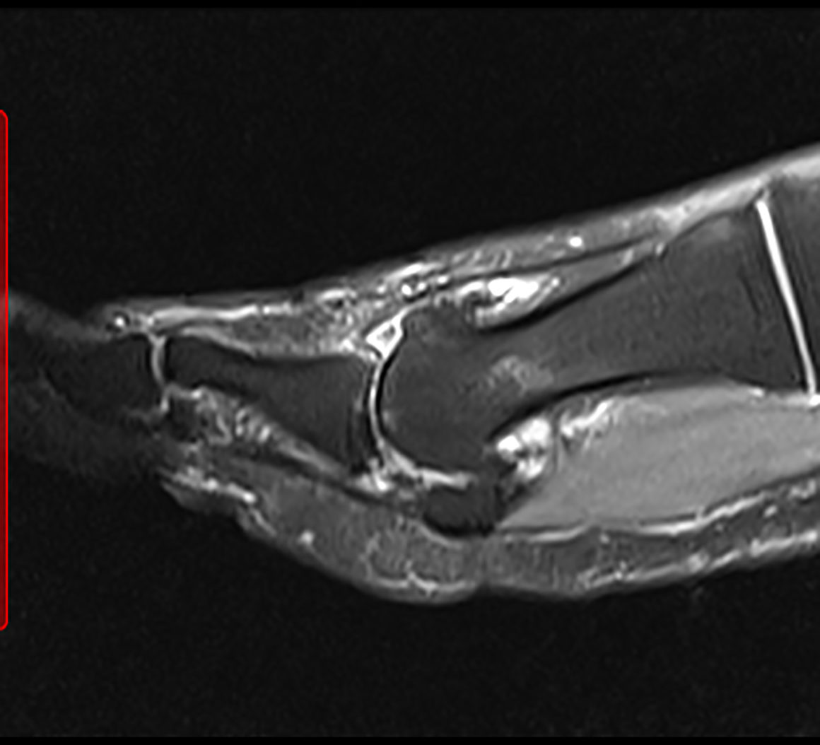 Hallux Rigidus (Big Toe Arthritis) The Foot and Ankle Clinic
