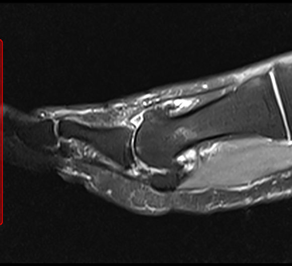 Hallux Rigidus (Big Toe Arthritis) The Foot and Ankle Clinic