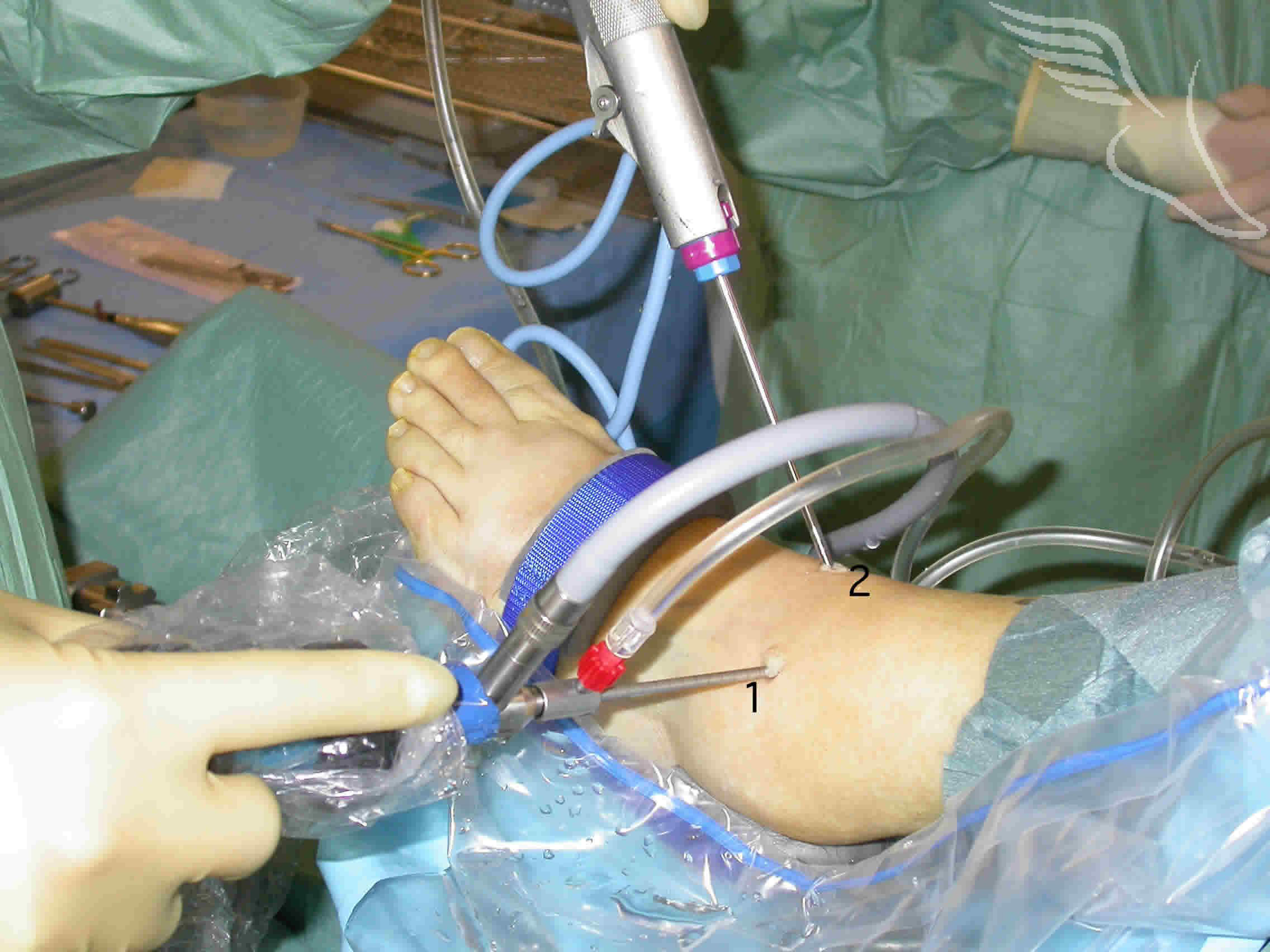 ankle-arthroscopy-25