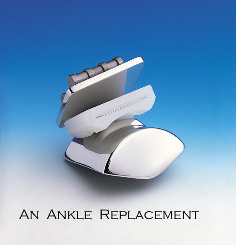 Ankle Replacement