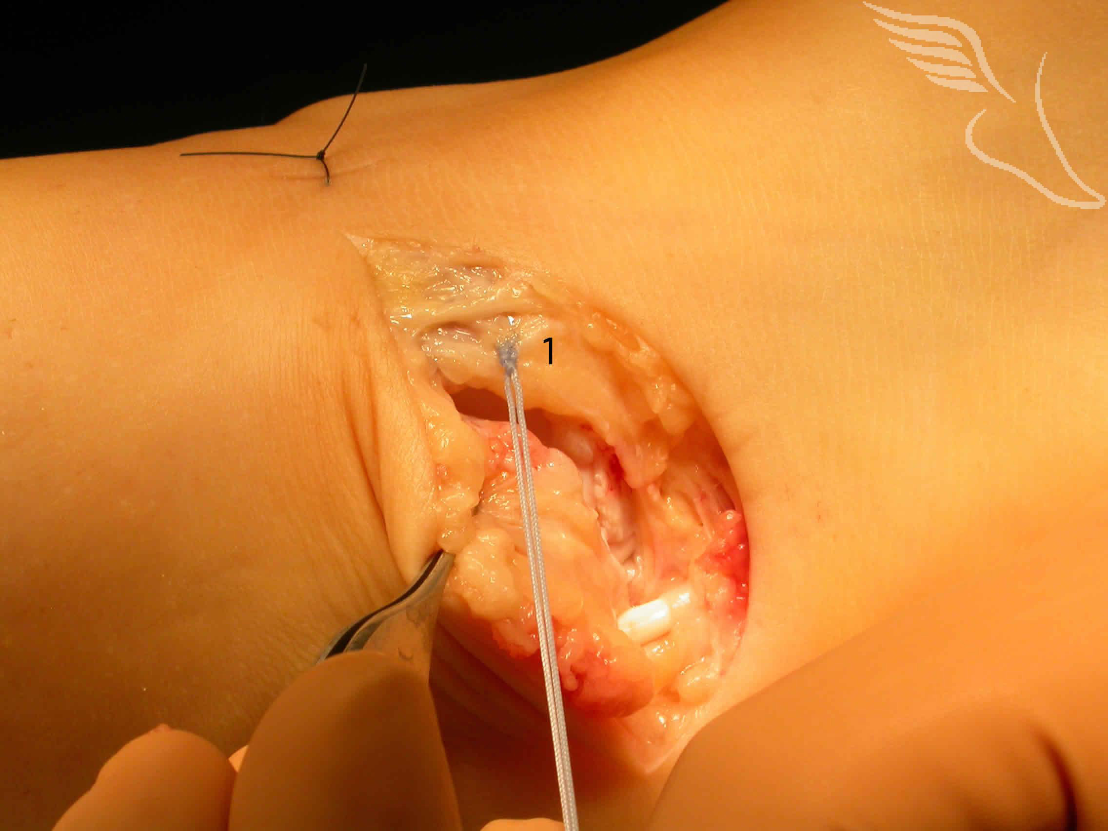 birmingham-ankle-ligament-reconstruction-13
