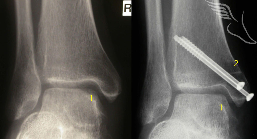 osteochondralgraftingthetalus24 The Foot and Ankle Clinic