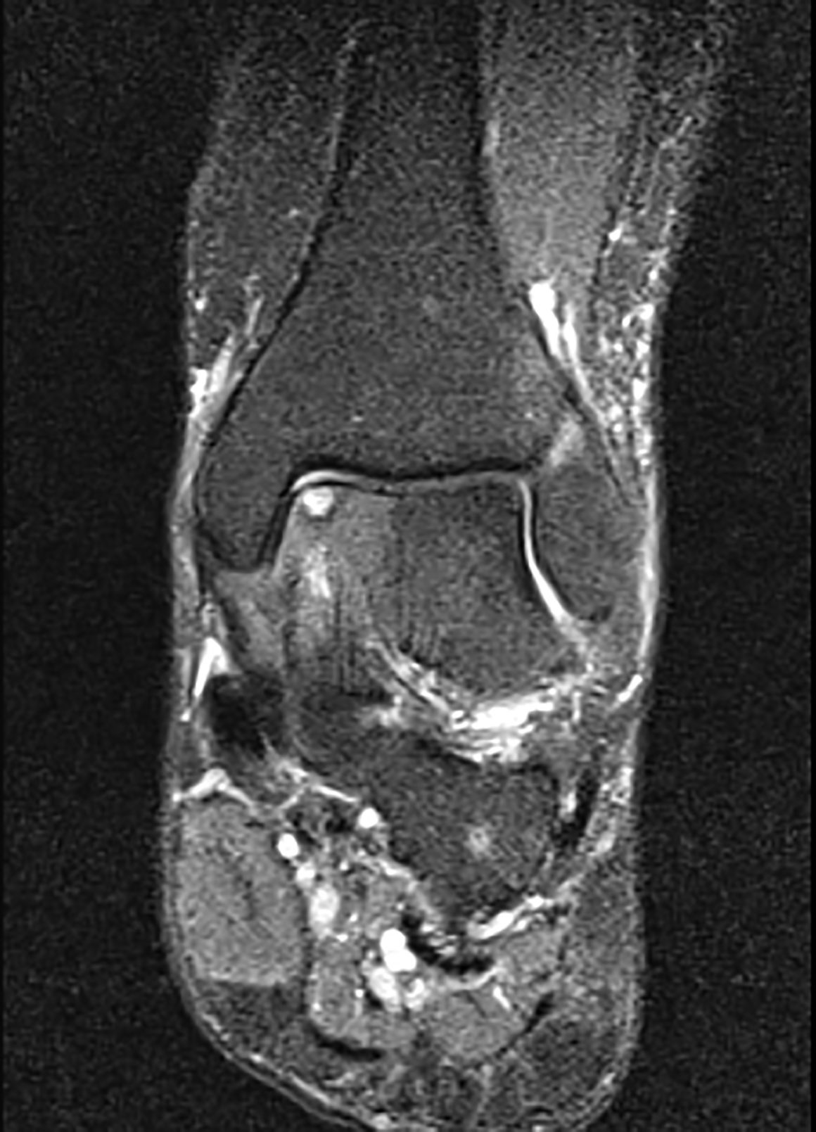 Osteochondral Defect