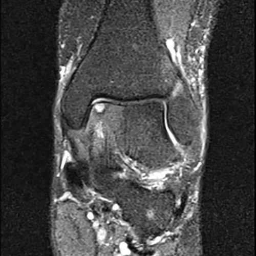 Osteochondral Defect